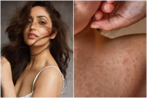 কেরাটোসিস-পিলারিসে ভুগেছেন Yami Gautam 9 pjimage 2021 12 27T121342.099