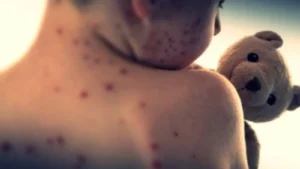 measles BD INSIDE KHABOR